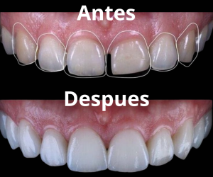 Estética Dental